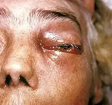 Periorbital fungal infection known as mucormycosis, or phycomycosis PHIL 2831 lores