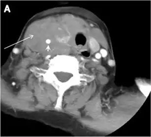 Fig. 12. Diffuse thyroid large B-cell lymphoma in a 79-year-old female patient. an Axial enhanced neck CT scan demonstrates a homogeneously hypodense and minimally enhancing large right thyroid solid mass (long white arrow) extending into the thyroid isthmus. It is encasing the right carotid artery (short white arrow) and displacing of the trachea and oesophagus to the left side.
